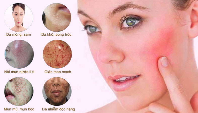 da bị nhiễm corticoid
