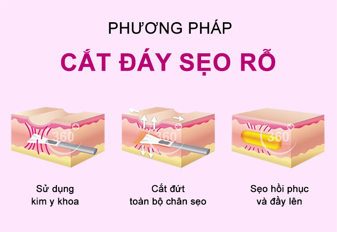 phương pháp cắt đáy sẹo rỗ
