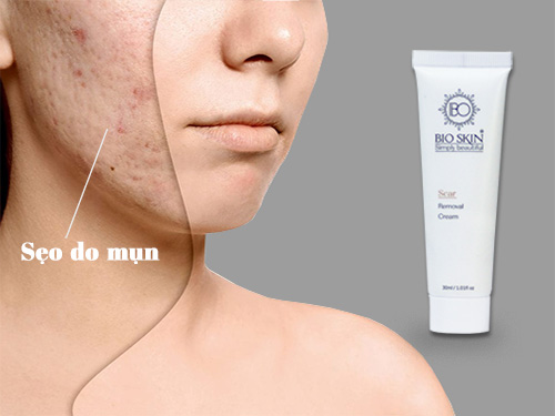 Quy Trình Điều Trị Sẹo Rỗ Với Dòng Dược Mỹ Phẩm Bio Skin