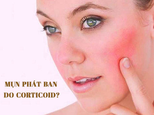 Quy Trình Điều Trị Mụn Phát Ban Do Corticoid